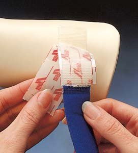 Alpha Splintstraps(Tm), Package - NOR15276